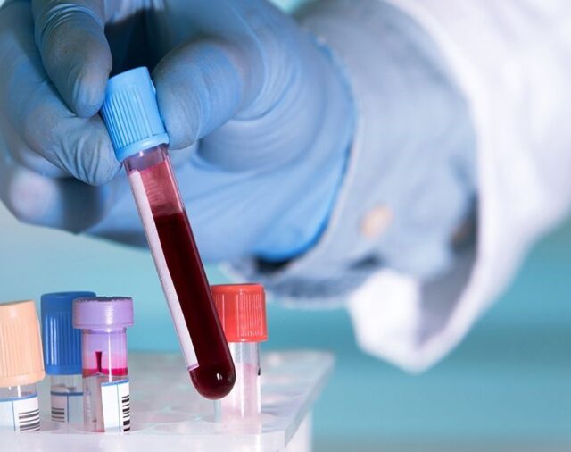 Un nuevo test de sangre permite la detección temprana de 50 tipos de cáncer