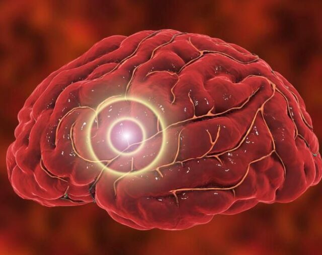 El radón, un "asesino oculto", podría aumentar el riesgo de accidente cerebrovascular