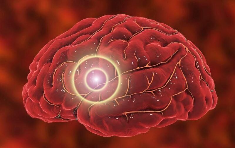 El radón, un "asesino oculto", podría aumentar el riesgo de accidente cerebrovascular