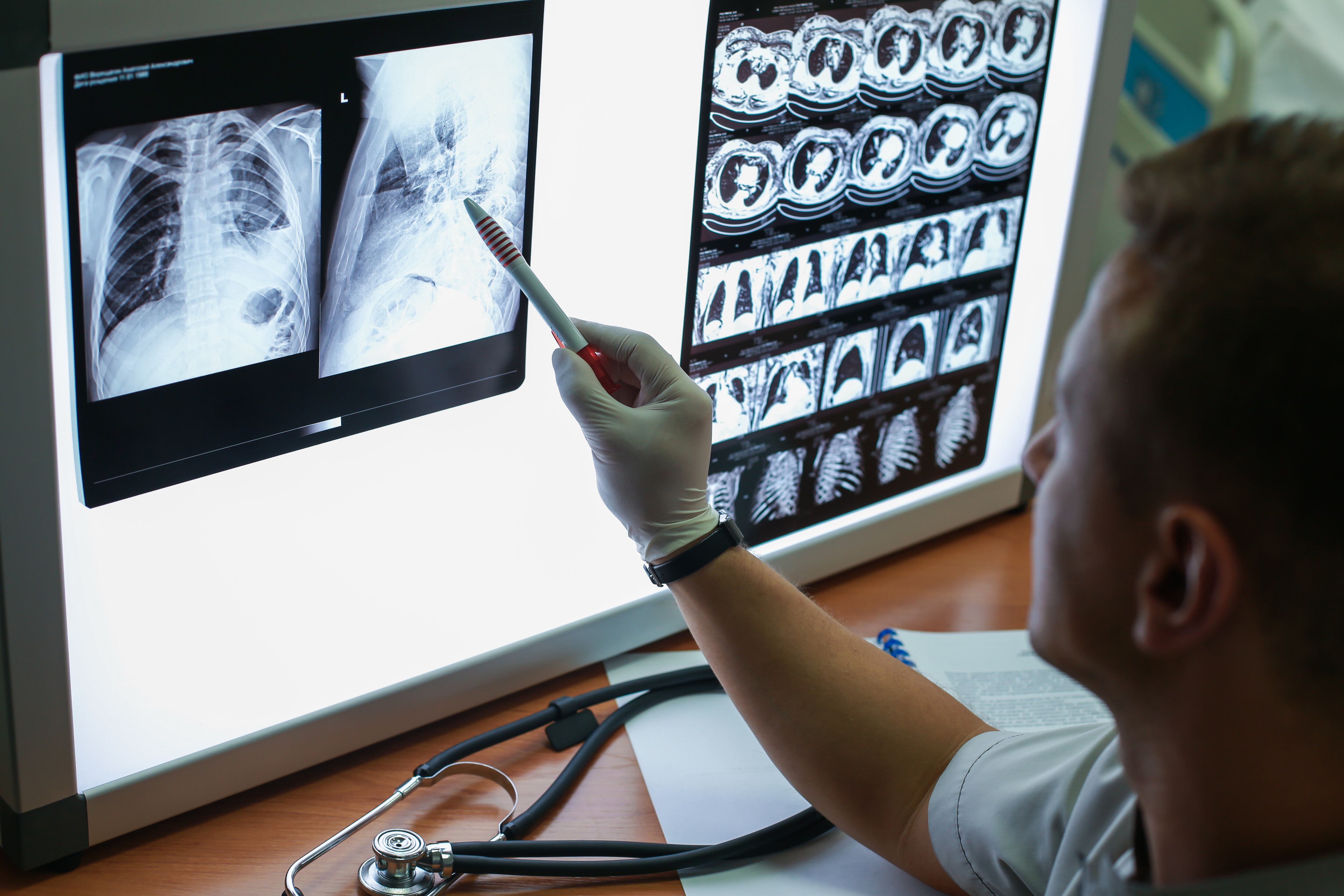 Un doctor observa una radiografía de pulmón (Shutterstock España)